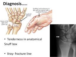 Hand Injuries Hõm lào giải phẫu (vi); hand injuries