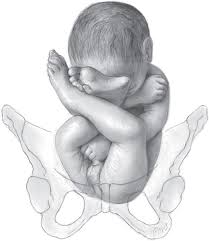 Image result for Breech Delivery