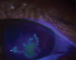 13 patients often present with the classic symptoms of hsv ocular infection such as redness, tearing, foreign body sensation, pain, photophobia and blurred vision. Be A Hero To Your Hsvk Patients