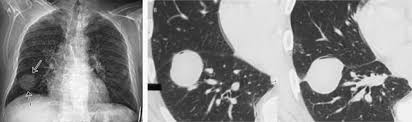 Check spelling or type a new query. Comparative Interpretation Of Ct And Standard Radiography Of The Pleura