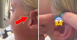 Nach 6 Jahren Frau Druckt Pickel Am Ohr Aus