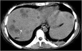 Focal or simple caroli disease consists of abnormally widened bile ducts affecting an isolated portion of liver. Hemobilia Como Forma Inusual De Presentacion En La Enfermedad De Caroli Revista Electronica De Portales Medicos Com