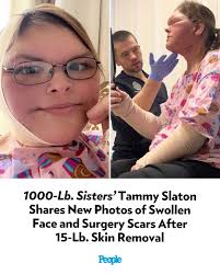 Tammy Slaton is sharing more photos from her recovery after skin removal  surgery. On June 11, the '1000-Lb. Sisters' star posted