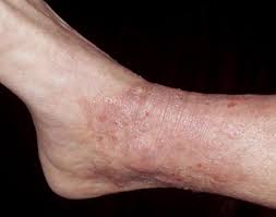 Image result for Lichen Simplex Chronicus