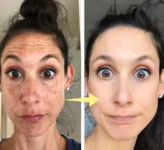 ✨Last Day Discount: 87%OFF-NESLEMY™ Remove freckle Facial Serum