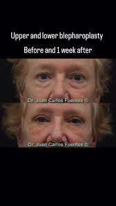The recovery after the blepharoplasty is fast. Usually 1 week after the  surgery the stitches are removed and most of the bruising is gone. This  video shows the results after 1 week. There is still ...