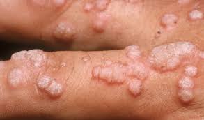 Hpv is a group of more than 200 related viruses, some of which are spread through vaginal, anal, or oral sex. What Is Hpv Jordan Associates Ob Gyn
