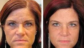 A daily skin care regimen is your best defense against wrinkles. How To Remove Forehead Lines Using Face Aerobics Workouts Want To Reduce Forehead Lines Fast And Without Botox Execute These Facial Workouts