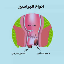 شكل البواسير الخارجية بالصور الحقيقية Nadormagazine Com مجلة الناظور الأولى