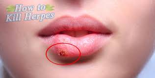 Most commonly, herpes type 1 causes sores around the mouth and lips (sometimes called fever blisters or cold sores). Herpes Simplex 1 How To Kill Herpes