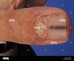 Mélanome acrolentigineux intra épidermique débutant CLARK I Stock Photo -  Alamy