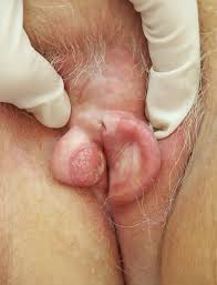 Image result for Vulvar Cancer