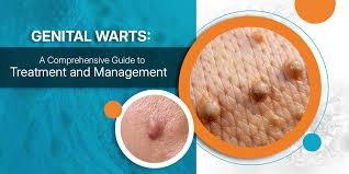Image result for genital warts