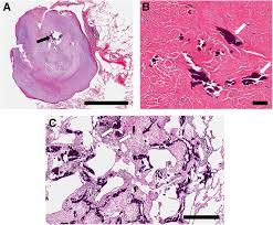 Image result for Broncholithiasis