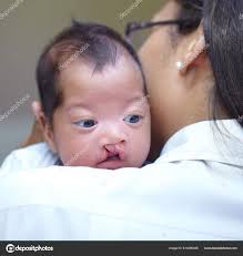 Imagens de Fenda palatina sem royalties