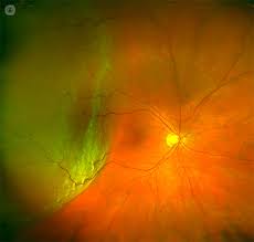 Warning Signs Of Retinal Detachment