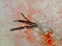 It may or may not be accompanied by an infection of the hair follicle (folliculitis) or razor bumps (pseudofolliculitis barbae), which vary in size. Multiple Two Hairs One Follicle On Scalp Armpit Pubic Area Get Rid Hair Mag