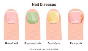 Image result for onychomycosis