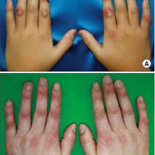 Lupus is a widespread and chronic autoimmune disease that, for unknown reasons, causes the immune system to attack the body's own tissue in an autoimmune disease like lupus, the immune system loses its ability to tell the difference between foreign substances and its own cells and tissue. Pdf Childhood Chilblain Lupus Erythematosus