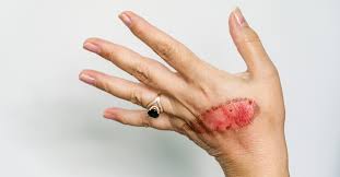 لون الجلد بعد الحرق تعرف على التغيرات والعلاجات ويب طب