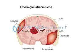 L'emorragia cerebrale primaria rappresenta l'80% circa di tutte le emorragie cerebrali ed è causata dall'ipertensione arteriosa o dall'angiopatia amiloide. Emorragia Cerebrale Nel Neonato Errore Medico E Risarcimento Danni