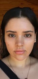 Vampire Facial (PRP)