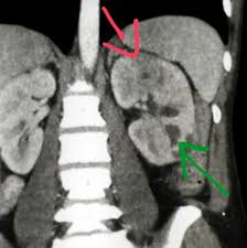 Early Signs Of Kidney Disease Kidney Infection Diagnostic Imaging Kidney Disease Symptoms
