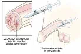 Image result for Intraurethral Alprostadil