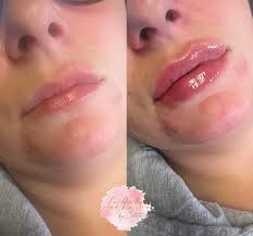 Recent Lip Filler before and afters 🫦💉 • • • #lipfiller #lipfillerleeds  #lipfilleruk #aesthetics #aestheticsleeds #aestheticsuk  #botoxbeforeandafter #botoxleeds #botoxuk #aestheticsnurse