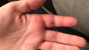 What does a redback bite feel like? Rat Bite Pictures Rat Bite Fever Treatment And Complications