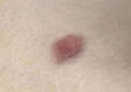 Image result for Dermatofibrosarcoma Protuberans