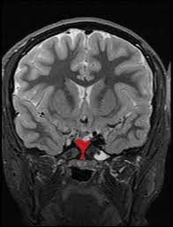 Morning Glory Syndrome Radiology Case Radiopaedia Org