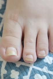 Image result for Yellow nail syndrome feet
