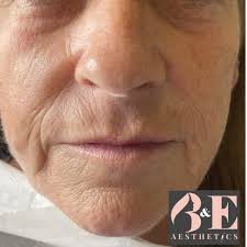 Seventy Hyal 2000💫 Hydrate💦 Glow✨Contour💉