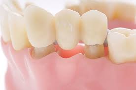 Yang termasuk dalam jenis gigi palsu ini adalah bridge, crown dan juga implan. Apa Itu Crown Dan Bridges Apakah Rohaya Dental Surgery Facebook