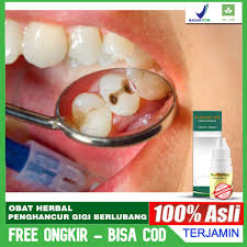 Sakit gigi berlubang dapat terasa sangat nyeri hingga menyebabkan anda tidak bisa makan, tidur, atau bahkan beraktivitas. Obat Penghancur Gigi Berlubang Perontok Karang Gigi Gigi Sering Nyut Nyutan Propolis Sm 100 Asli Shopee Indonesia