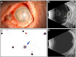 Image result for Ciliary Flush