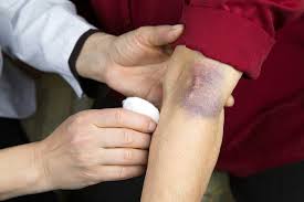 Image result for Contusion