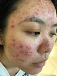 Maybe you would like to learn more about one of these? How To Treat Hormonal Acne Naturally And With Pills Nigerian Health Blog