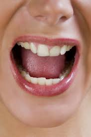 New cavities can begin to form within as little as three months after dry mouth begins. Burning Tongue Burning Mouth Syndrome Causes And Home Remedies
