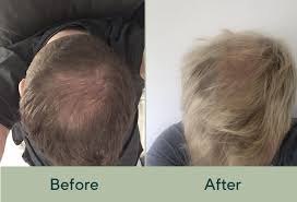 Dht is a hormone that has been linked to hair loss in women and men. Success Story Joe S Hair Regrowth Manual