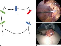 Intestinal or omental injury can occur if the trocar is … Hybrid Approach To Ventral Wall Hernia Repair A Single Institution Cohort Study Springerlink