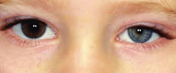 Congenital Horner Syndrome With Iris Heterochromia The Affected Side Download Scientific Diagram