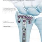 2.4 mm Variable Angle LCP® Volar Rim Distal Radius Plates ...