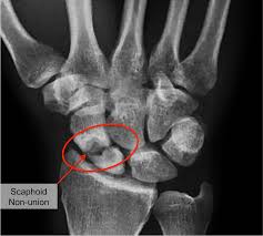 Image result for Scaphoid Bone