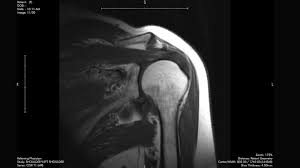 Image result for Shoulder MRI