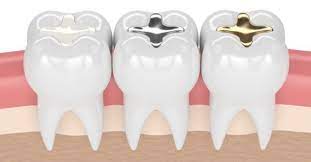Tooth Filling Guide Cost And Types Cavity Filling Dental Fillings Tooth Filling