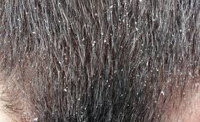 Rosmarin Gegen Schuppen Auf Der Kopfhaut Schuppenflechte Schuppenflechte Hausmittel Schuppenflechte Kopfhaut