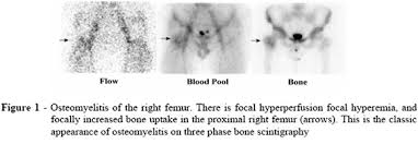 Image result for Osteomyelitis Bone Scan