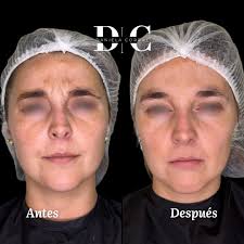 Resultado de Botox a los 14 días de inyección de Botox en ✓frente ✓patitas  de gallo ✓entrecejo ✓nasal Miren la diferencia en la dinámica facial al  hacer gesticulaciones. Esto es gracias a